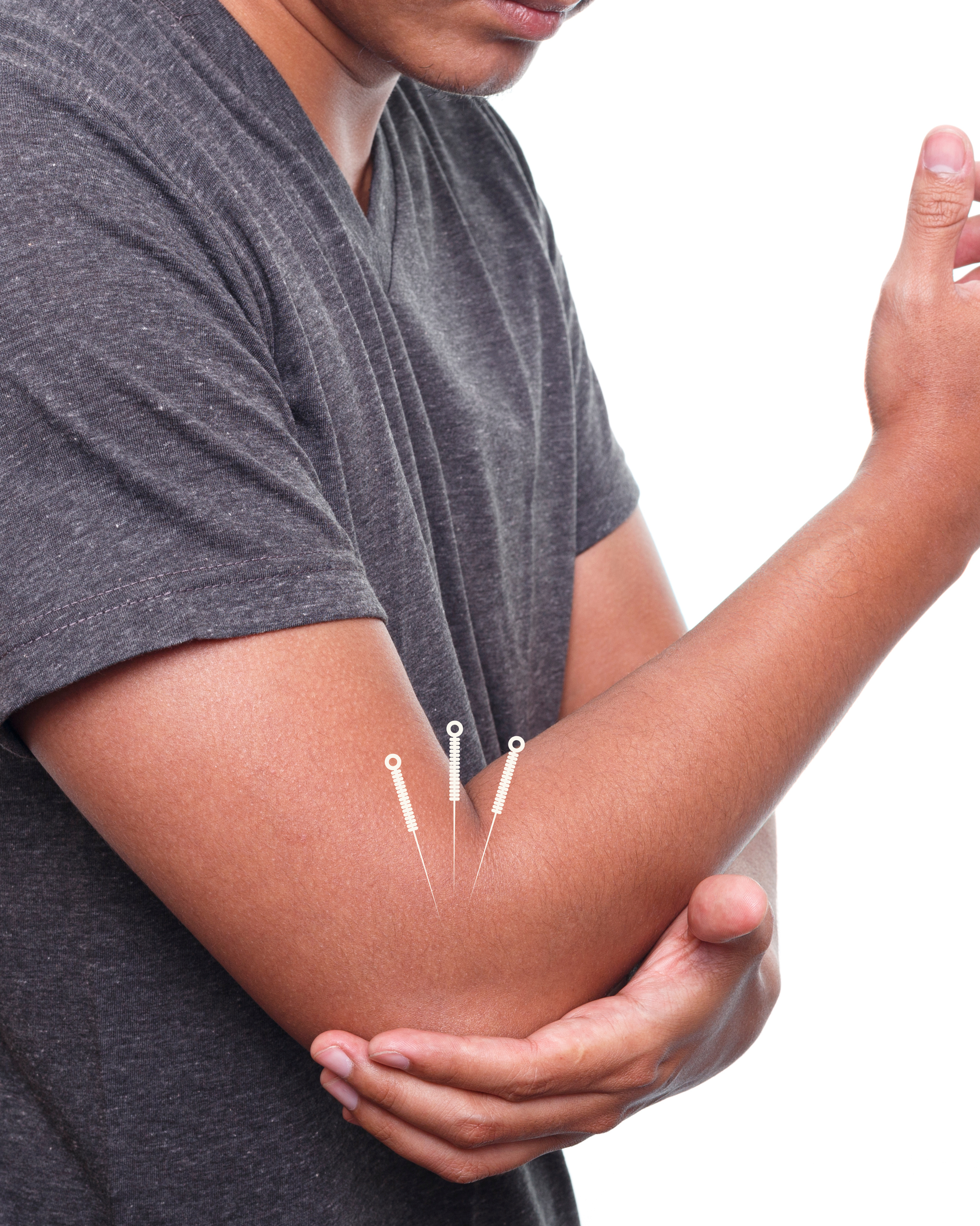 Tennis Elbow: Acupuncture